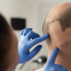 Alopecia Totalis: A Patient