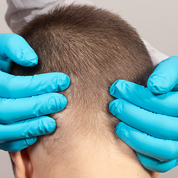 Is a Hair Transplant Without Shaving Hair Possible?