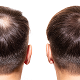 Do you Need A Second Hair Loss Treatment - Read to Know