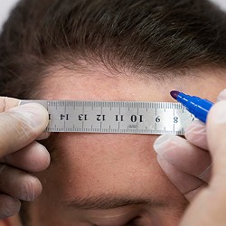 Why does Hairline Design Matters Most in Hair Transplant?